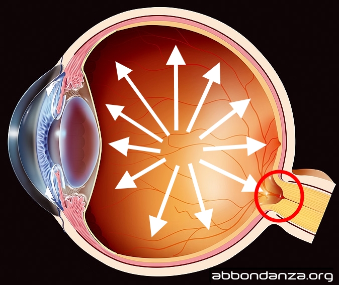 L'azione del glaucoma