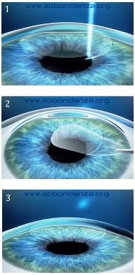 Le 3 fasi dell'intervento SMILE per la correzione dei difetti della vista