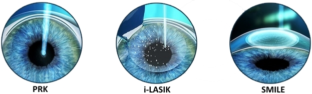 Le differenze di PRK, Femto-LASIK e SMILE per la correzione dei difetti visivi