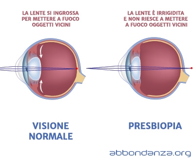 cura presbiopia con laser