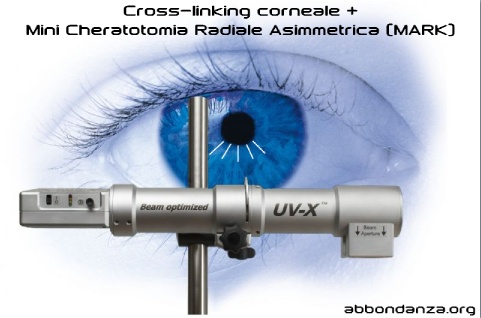 Cross-linking + MARK per cheratocono - Studi Oculistici Abbondanza